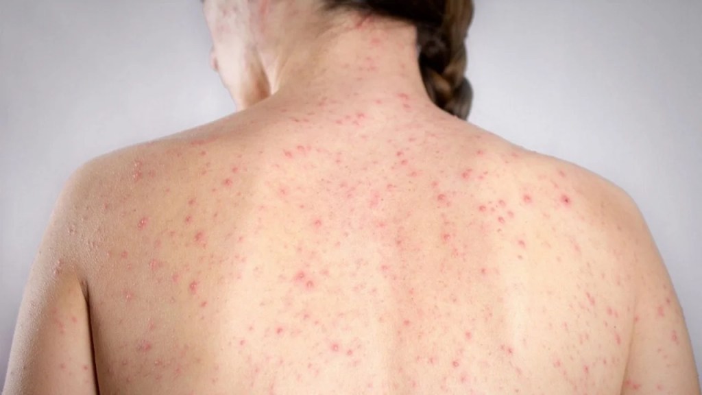 “¡Vacuná a tu hijo, ya!”: el desesperado ruego del Ministro de Salud por el brote de sarampión en&nbsp;Argentina